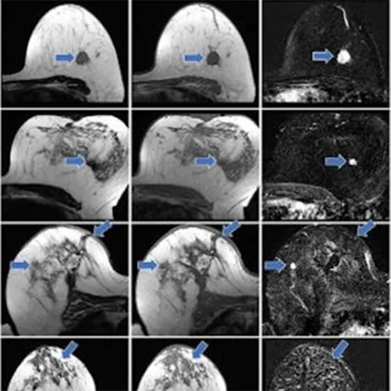 Contrast Based MRI, It's Indications and Uses